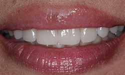 The after look of our patient's teeth and smile