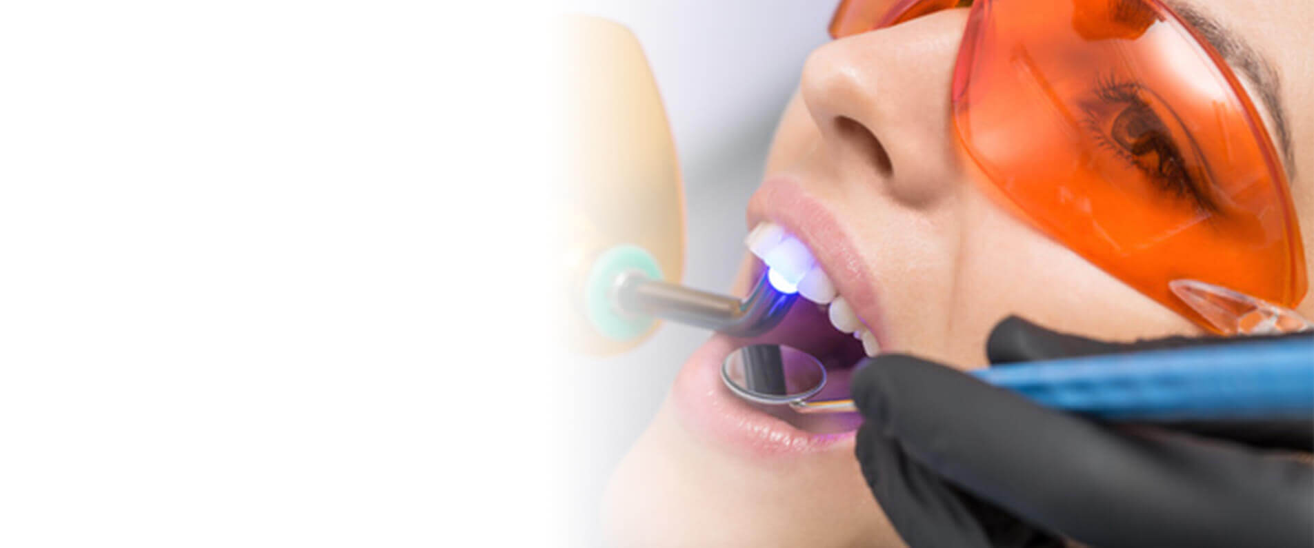 Top Dental Bonding Treatment in Fairfax VA by Optimal Dental Center