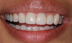 A Person with perfect teeth after treatment