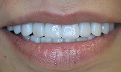 A Person with good perfect teeth after treatment