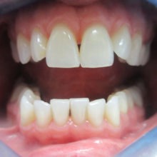 A Person having irregular teeth before treatment