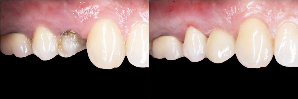 dental bridge infection treatment
