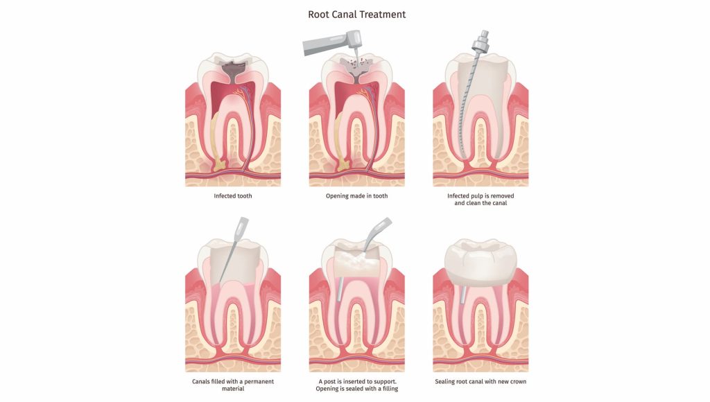 root canal vs tooth extraction
