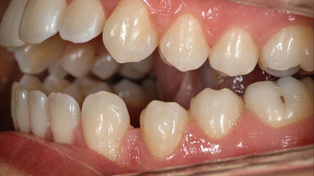 how to replace a pulled tooth