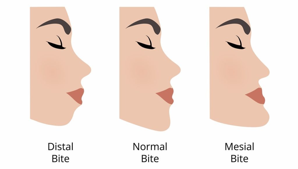 replacing extracted tooth