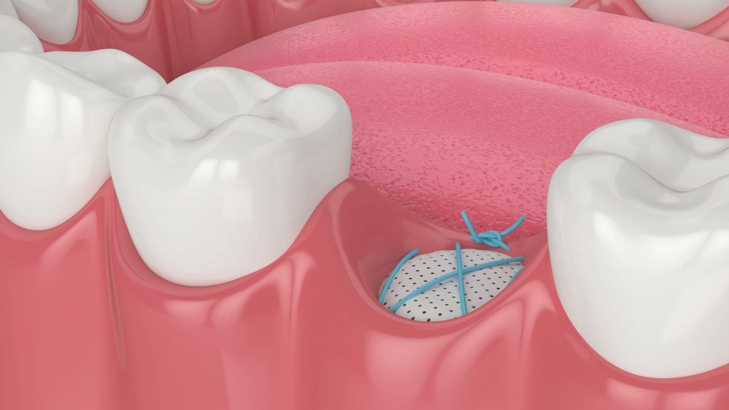 what happens if you lose a tooth and don't replace it