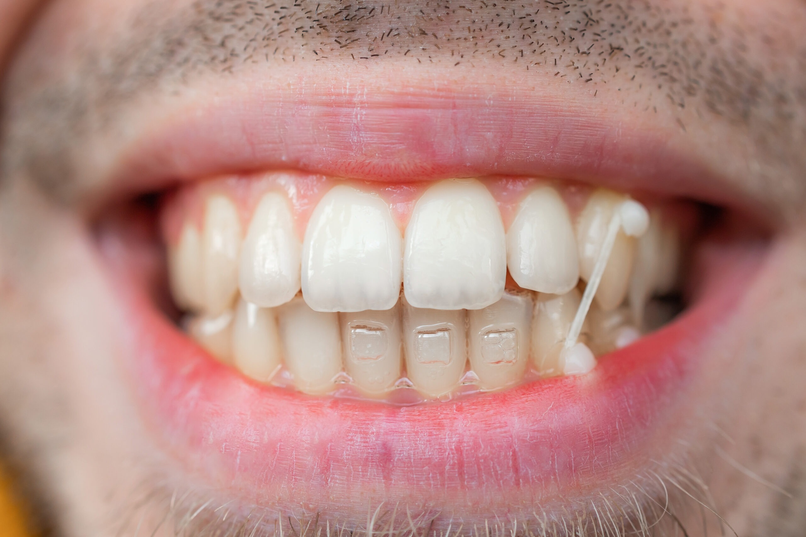Invisalign Attachments Explained in Simple Terms