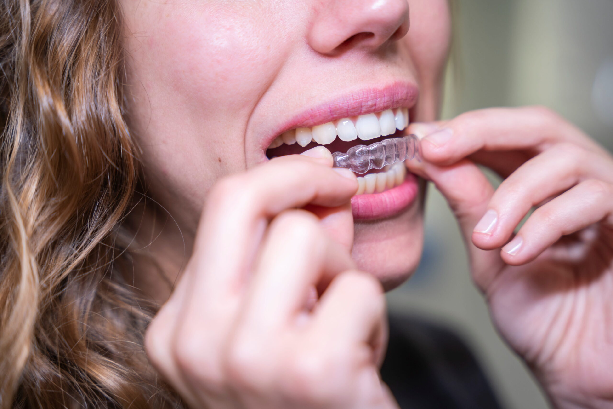 Invisalign® Myths vs. Facts: What Reston Patients Should Really Know